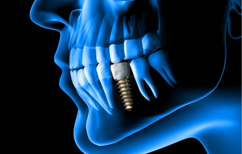 Ποια είναι τα καλύτερα εμφυτεύματα δοντιών