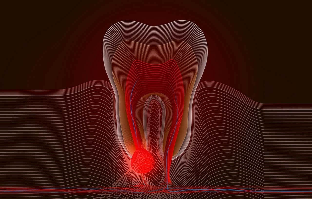 Root Canal Therapy in one visit