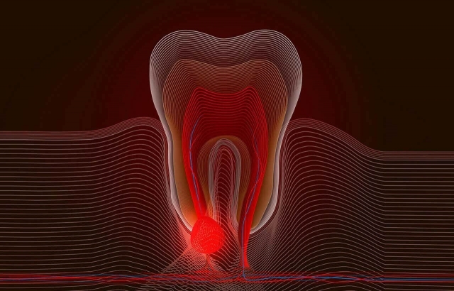 Root Canal Therapy in one visit