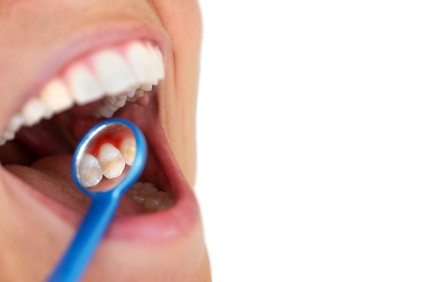 Everything you need to know about gingivitis