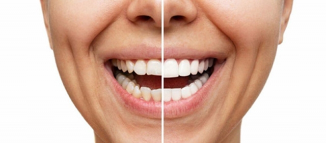 Όψεις Ρητίνης &amp; Όψεις Πορσελάνης: Ποια είναι η κατάλληλη επιλογή για το χαμόγελό σας;