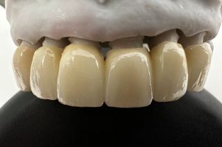 τεχντητες οδοντοστοιχιες